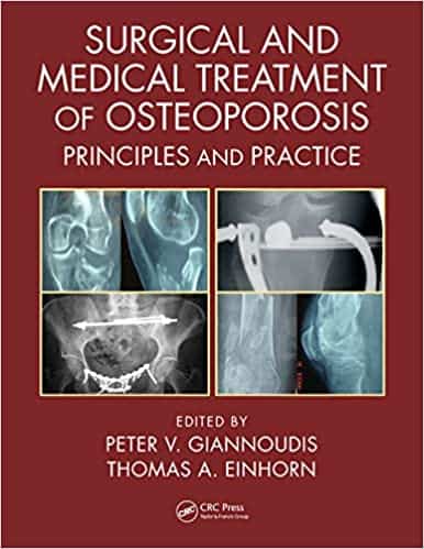 (eBook PDF)Surgical and Medical Treatment of Osteoporosis: Principles and Practice by Peter V. Giannoudis, Thomas A. Einhorn