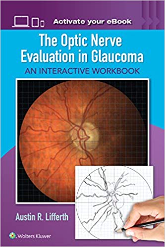 (eBook PDF)The Optic Nerve Evaluation in Glaucoma by Austin Lifferth 