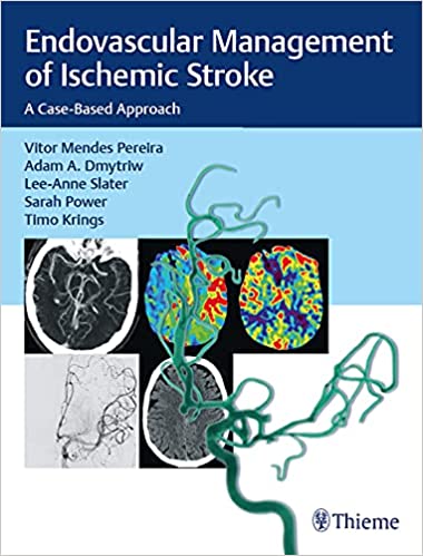 (eBook PDF)Endovascular Management of Ischemic Stroke: A Case-Based Approach 1st Edition by Vitor Mendes Pereira , Adam A. Dmytriw