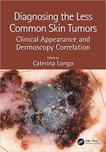 (eBook PDF)Diagnosing the Less Common Skin Tumors by Caterina Longo 
