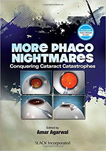 (eBook PDF)More Phacoo Nightmares by Amar Agarwal MS FRCS FRCOphth 