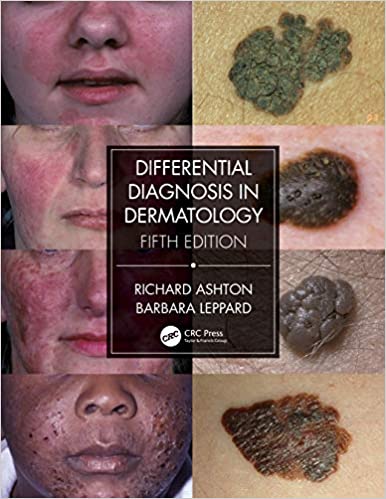 (eBook PDF)Differential Diagnosis in Dermatology 5th Edition by Richard Ashton, Barbara Leppard 