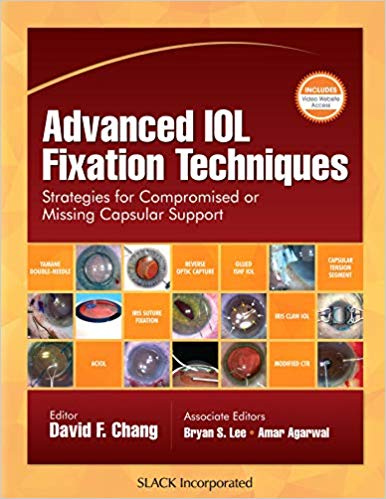 (eBook PDF)Advanced IOL Fixation Techniques strategies for compromised or missing capsular support by David F. Chang MD 