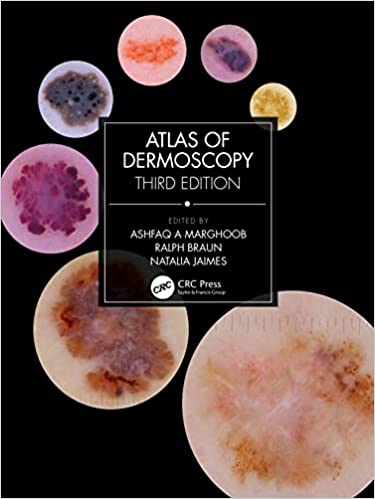 (eBook PDF)Atlas of Dermoscopy 3rd Edition by Ashfaq A Marghoob , Natalia Jaimes , Ralph Braun 