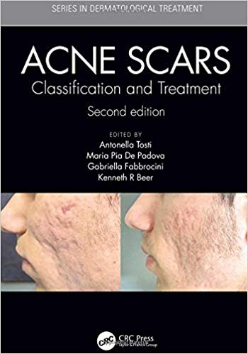 (eBook PDF)Acne Scars: Classification and Treatment by Antonella Tosti , Maria Pia De Padova , Gabriella Fabbrocini , Kenneth R Beer 