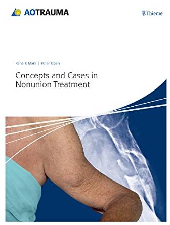 (eBook PDF)Concepts and Cases in Nonunion Treatment (AO Trauma Handbooks) 1st Edition by Weber and Cech in the early 1970s. With this new book the Editors Ren＆eacute; K