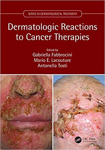 (eBook PDF)Dermatologic Reactions to Cancer Therapies by Gabriella Fabbrocini , Mario E. Lacouture , Antonella Tosti 