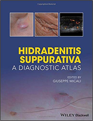 (eBook PDF)Hidradenitis Suppurativa: A Diagnostic Atlas by Giuseppe Micali 