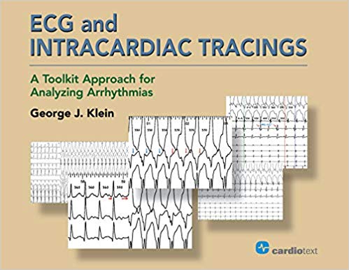 (eBook PDF)ECG and Intracardiac Tracings: A Toolkit Approach for Analyzing Arrhythmias