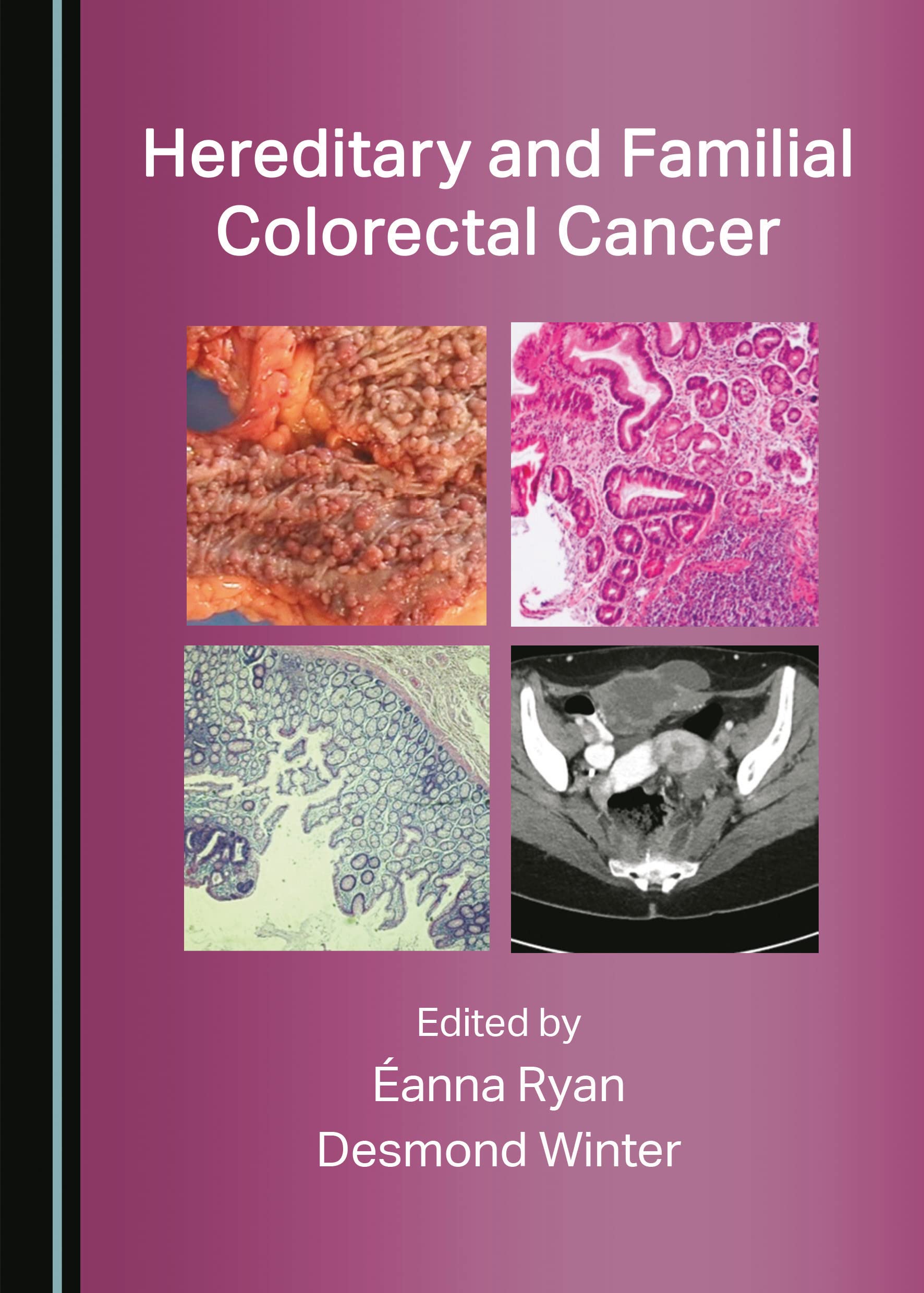 Hereditary and Familial Colorectal Cancer (Original PDF) by  Desmond Winter 