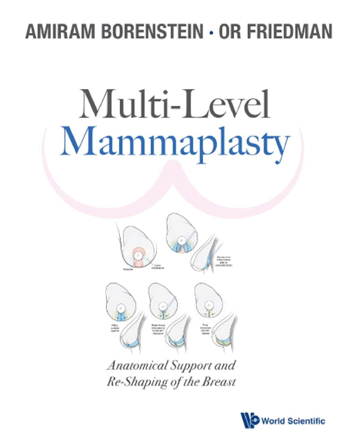 Multi-Level Mammaplasty: Anatomical Support and Re-Shaping of the Breast by Amiram Borenstein