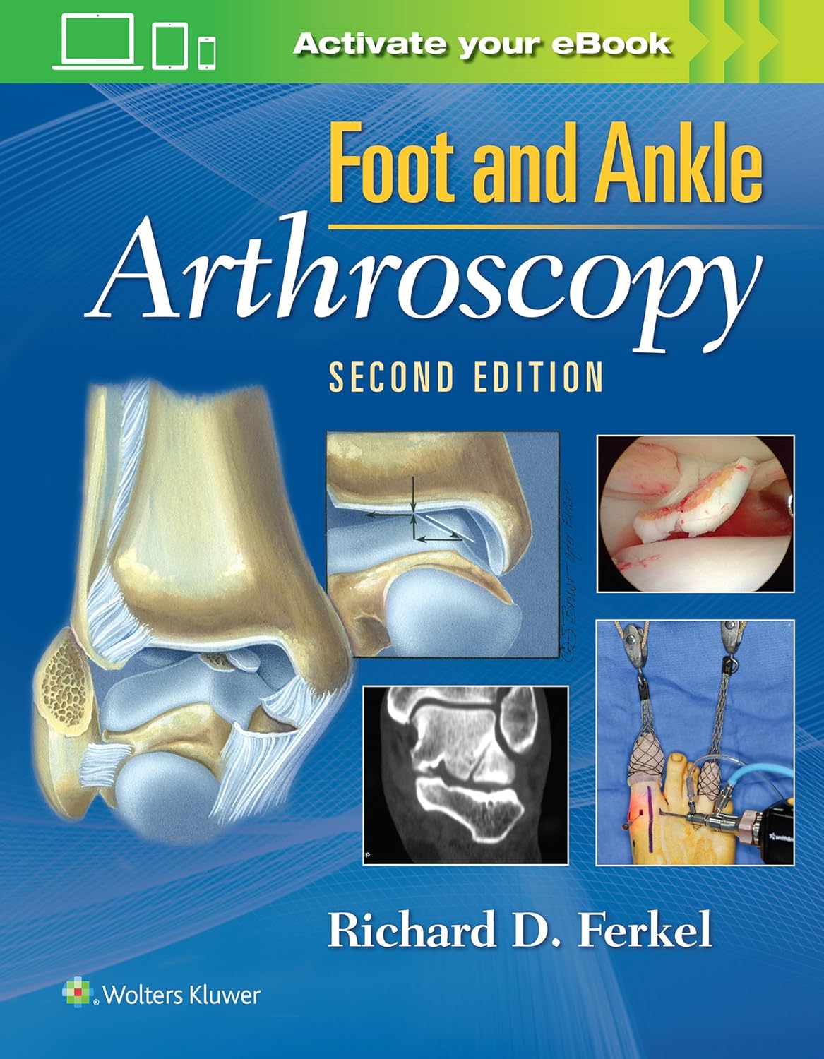 Foot ＆amp; Ankle Arthroscopy, 2nd Edition  by Richard D Ferkel MD