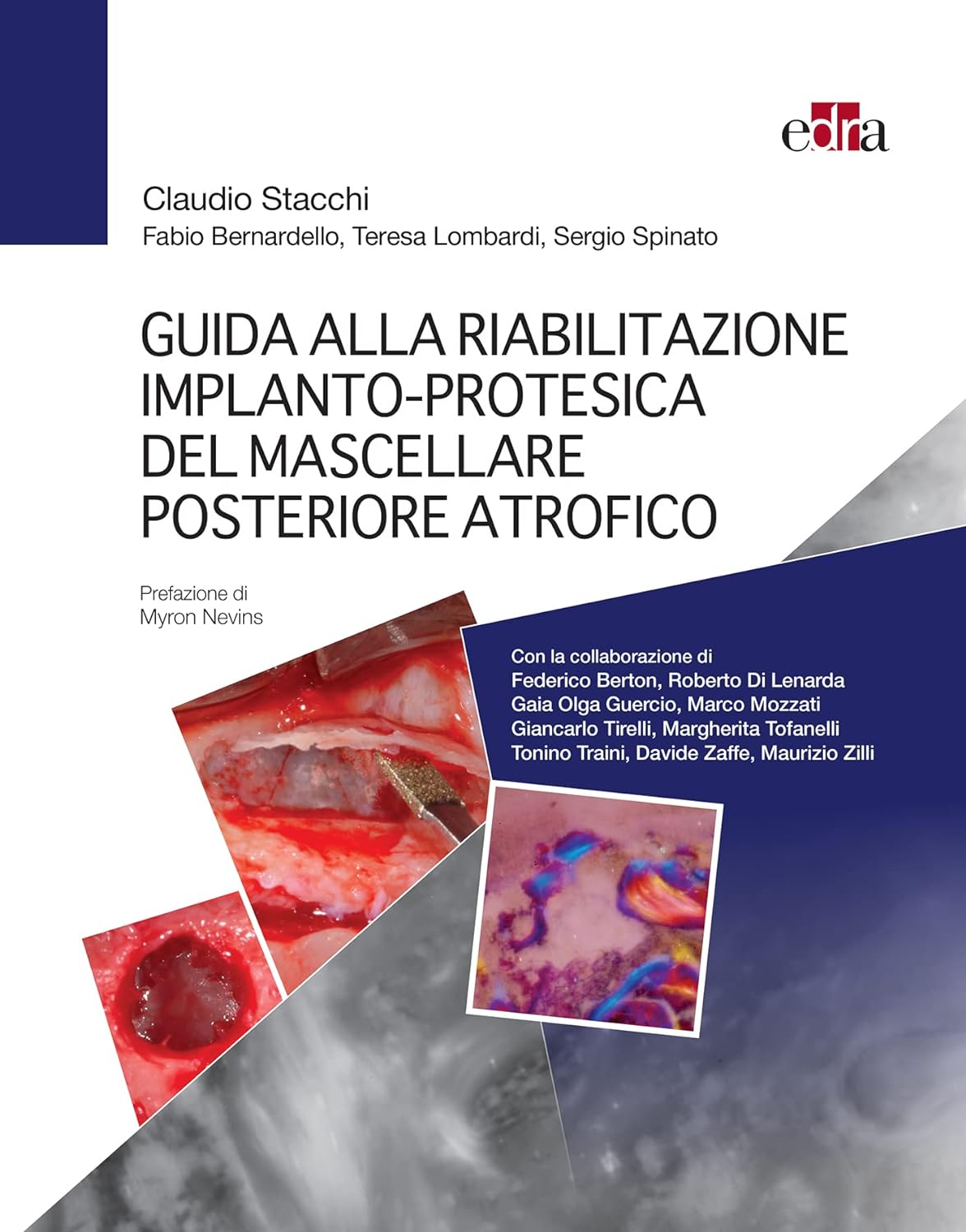 Guida alla riabilitazione implantoprotesica del mascellare posteriore atrofico (EPUB3 + Converted PDF) by  Claudio Stacchi 
