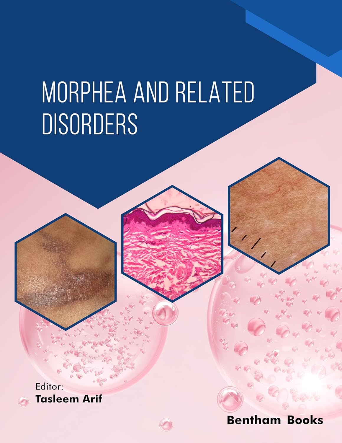 (EBook PDF) Morphea and Related Disorders by Tasleem Arif