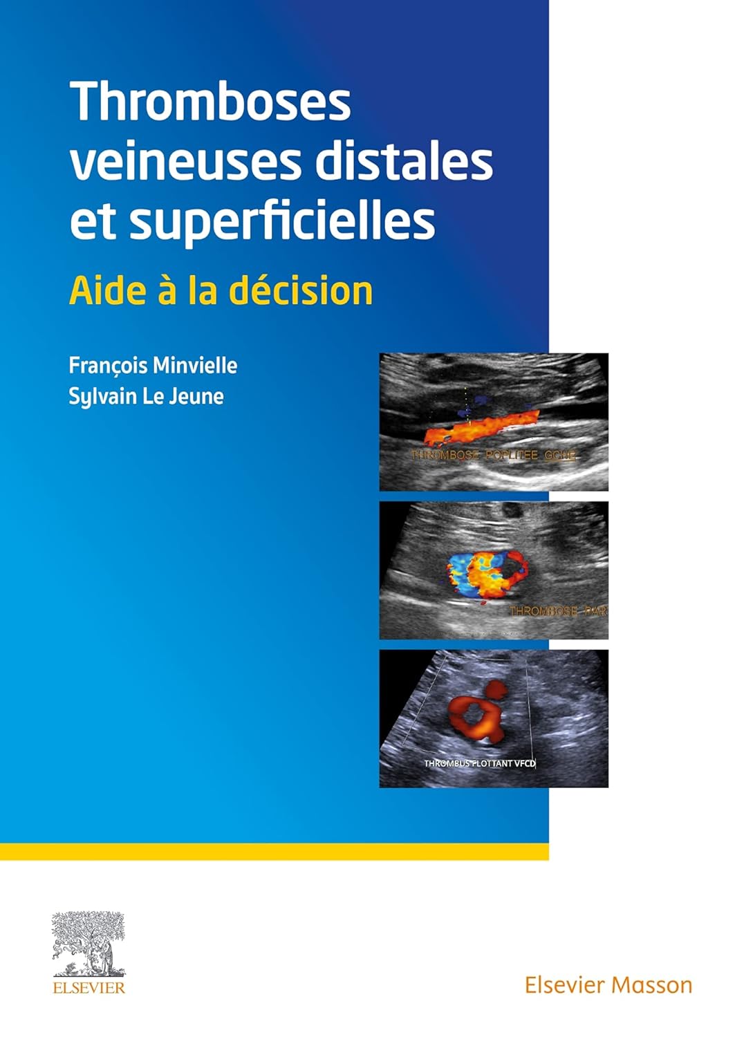 Thromboses veineuses distales et superficielles: Aide ＆agrave; la d＆eacute;cision (French Edition)  by Fran＆ccedil;ois Minvielle 