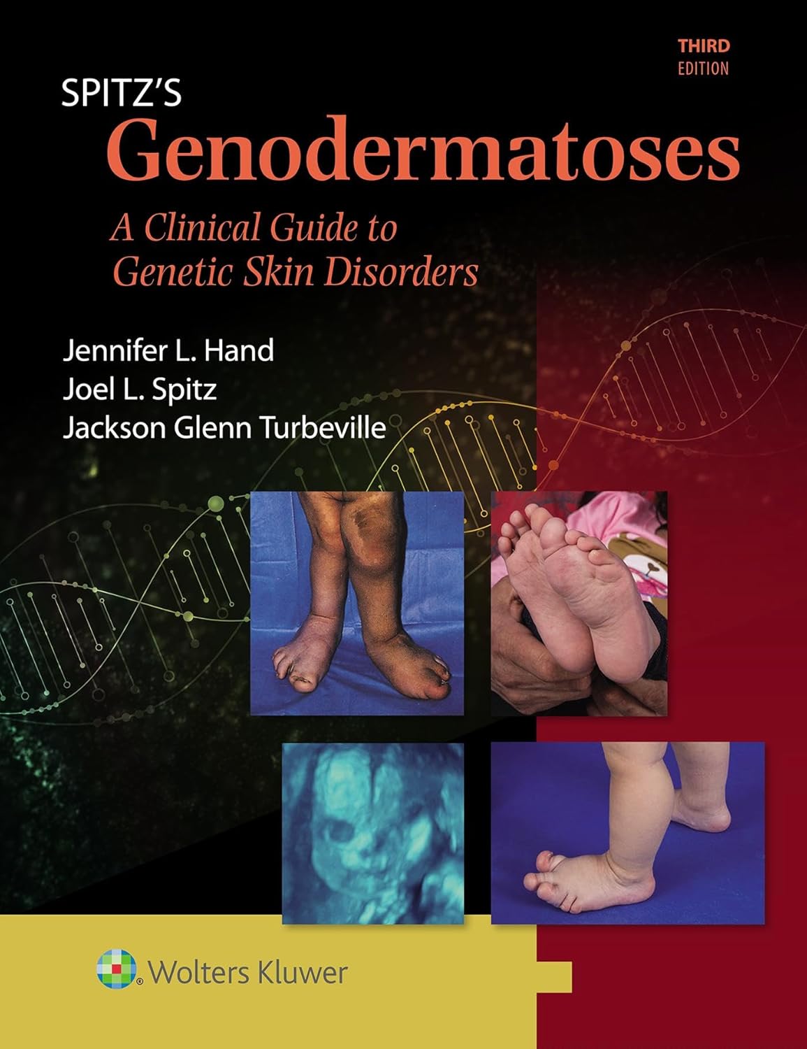 (EBook PDF)Spitz s Genodermatoses: A Full Color Clinical Guide to Genetic Skin Disorders, 3rd edition by Joel L. Spitz MD, Jennifer Lynn Hand MD, Jackson Glenn Turbeville