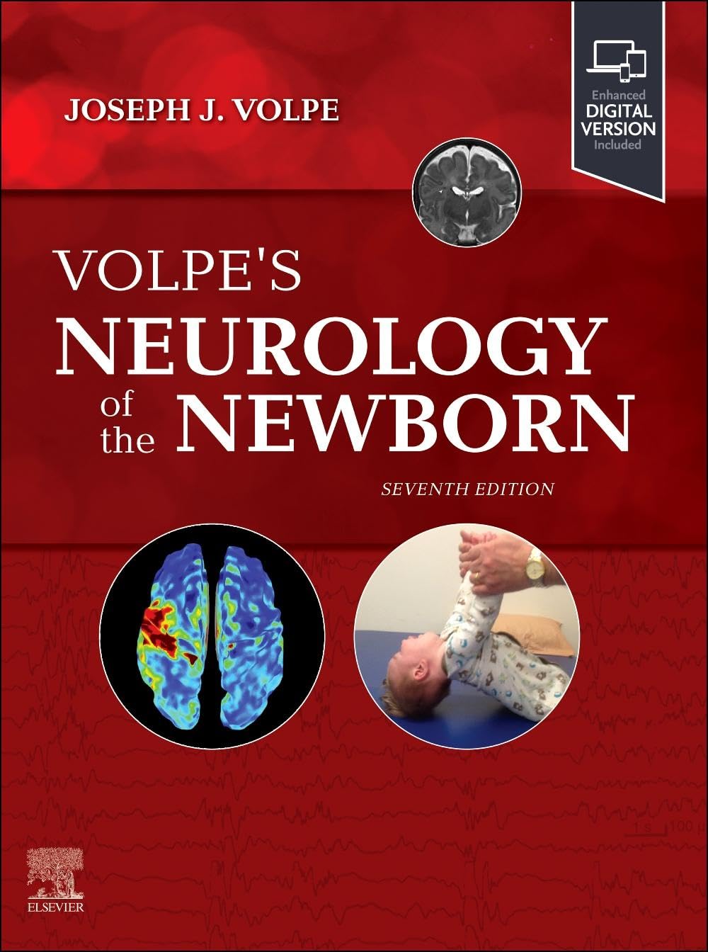 (EBook PDF)Volpe s Neurology of the Newborn 7th Edition by Joseph J. Volpe MD, Terrie E. Inder MB ChB MD