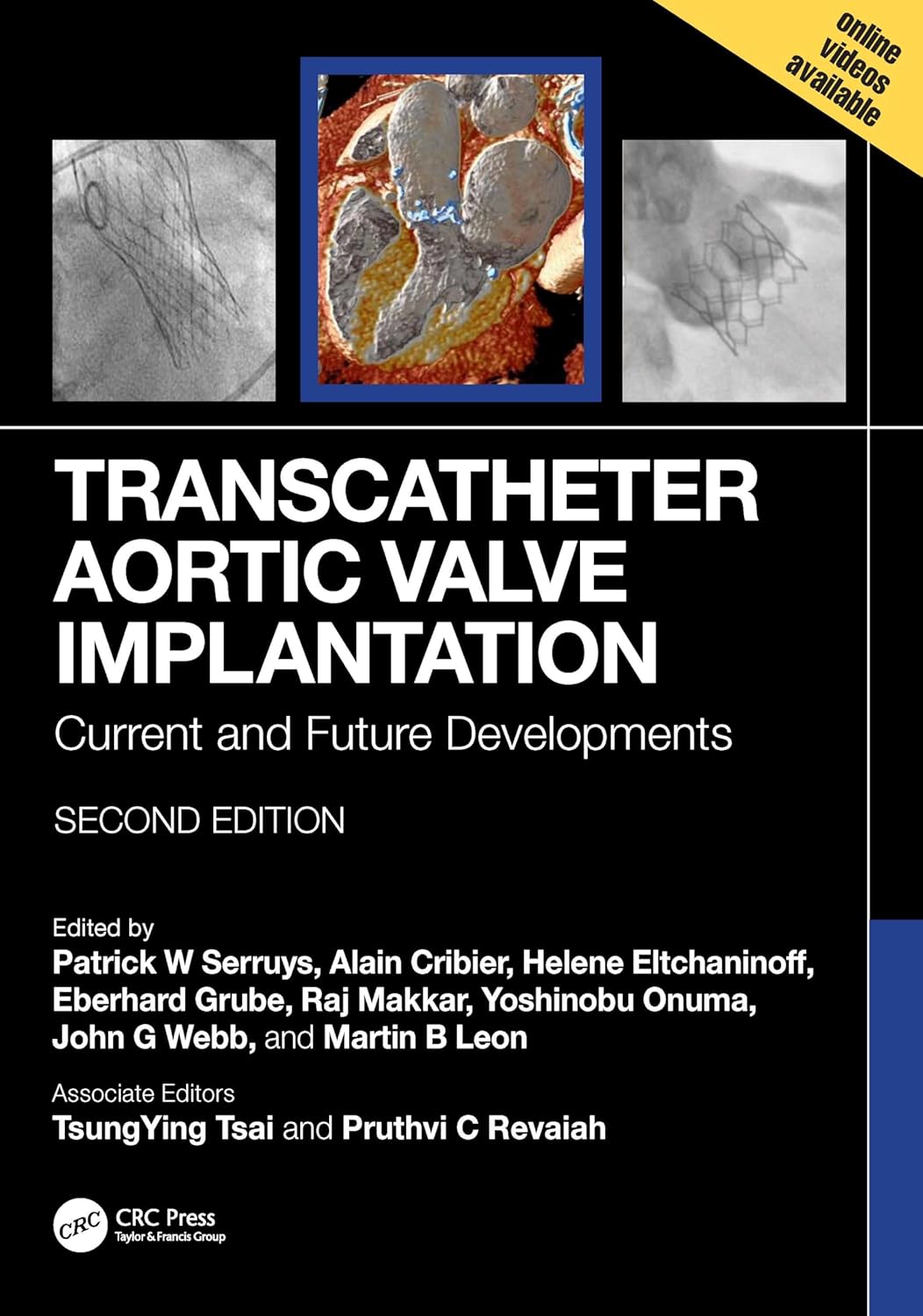 Transcatheter Aortic Valve Implantation by  Patrick W. Serruys