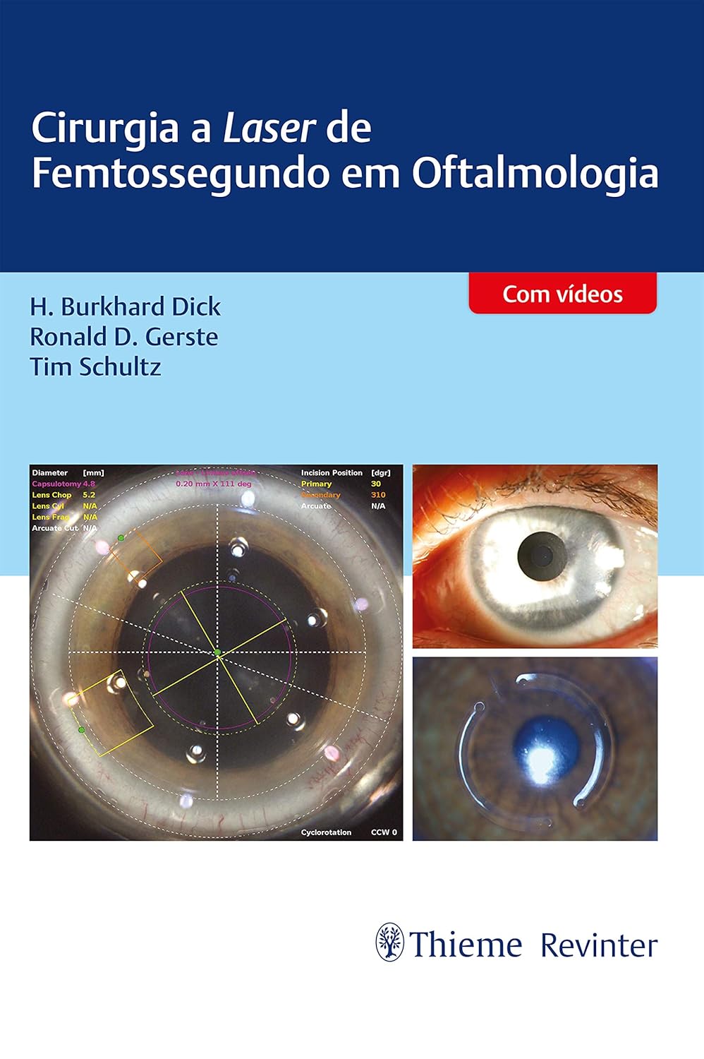 (EBook PDF)Cirurgia a Laser de Femtossegundo em Oftalmologia (Portuguese Edition) by H. Burkhard Dick, Ronald D. Gerste, Tim Schultz