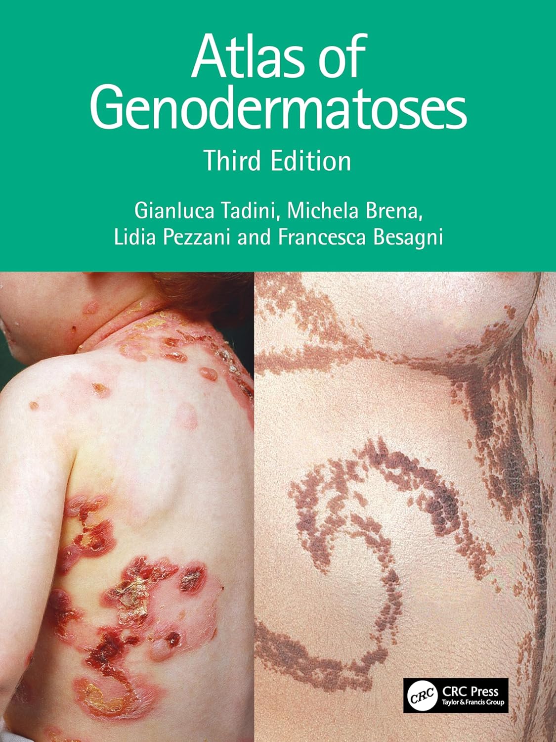 (EBook PDF)Atlas of Genodermatoses 3e by Gianluca Tadini, Michela Brena, Francesca Besagni, Lidia Pezzani