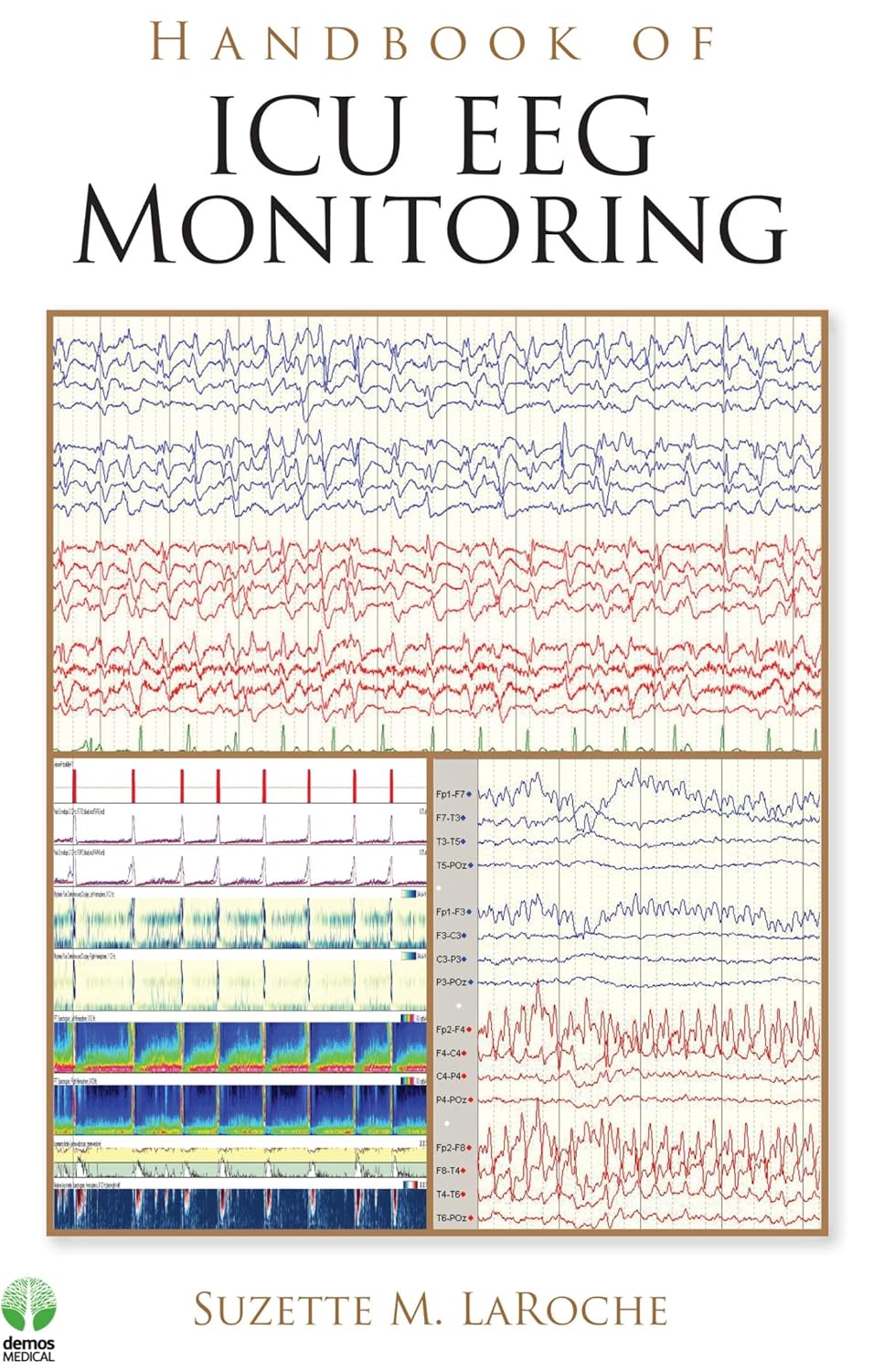  (eBook PDF)   Handbook of ICU EEG Monitoring 1st Edition by  Suzette LaRoche MD