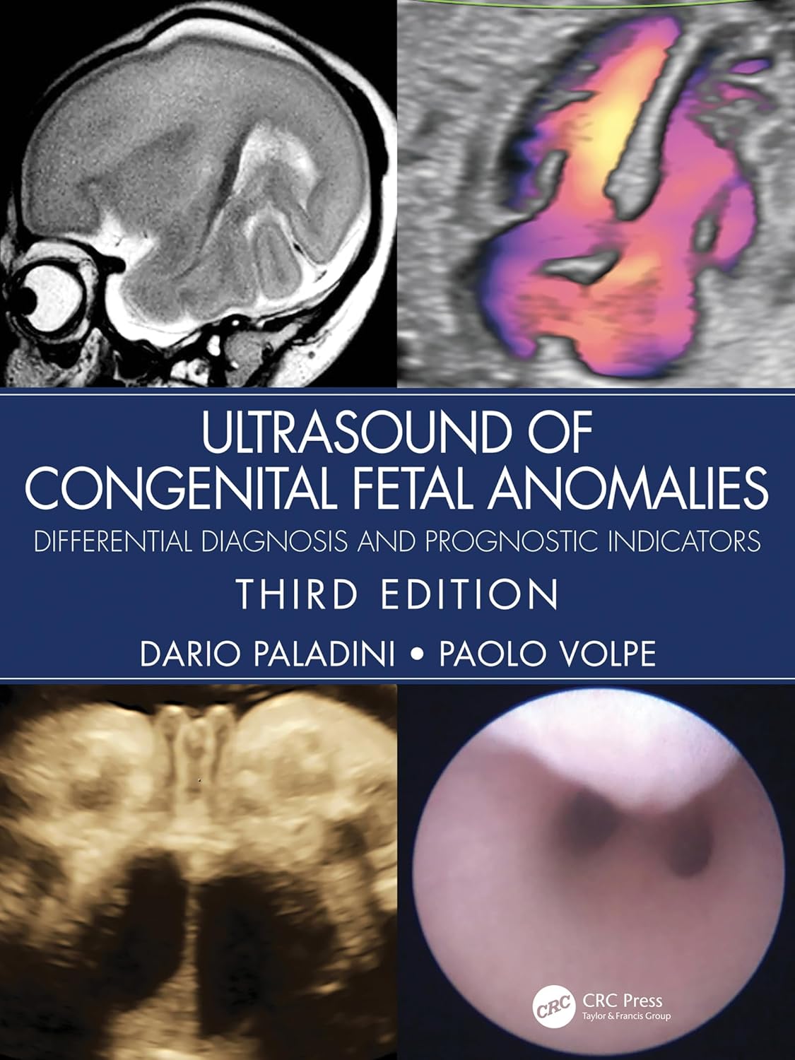 (eBook PDF)Ultrasound of Congenital Fetal Anomalies: Differential Diagnosis and Prognostic Indicators 3rd Edition by Dario Paladini, Paolo Volpe